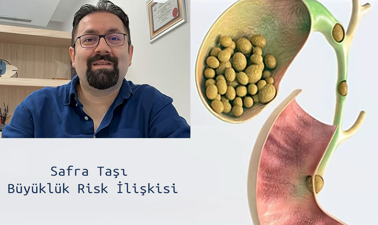Safra Taşı Büyüklük Risk İlişkisi Doç. Dr Çağhan Pekşen Genel Cerrahi Uzmanı