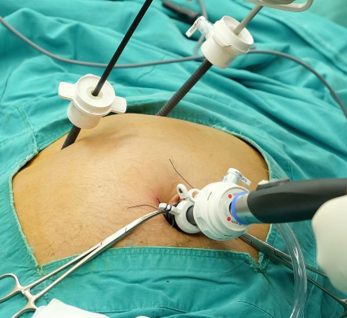 Safra Kesesi Polip ve Kanseri Tedavisi Doç.Dr Çağan Pekşen Genel Cerrahi Uzmanı Laparosopik Kapalı Safra Kesesi Ameliyatı Yorumları